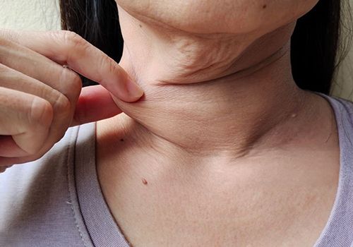 Flacidez facial leve/moderada