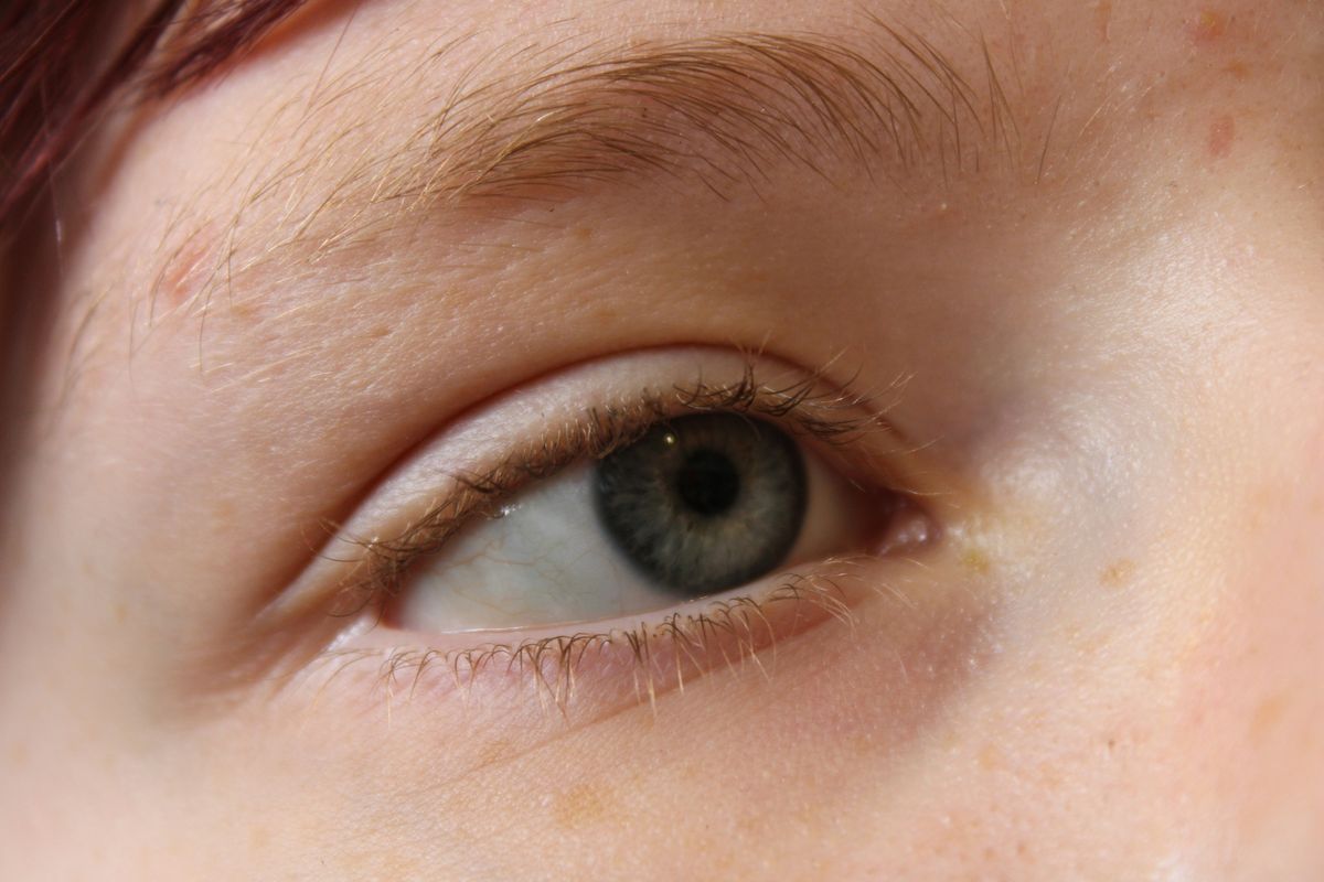 Ojeras (valoración)