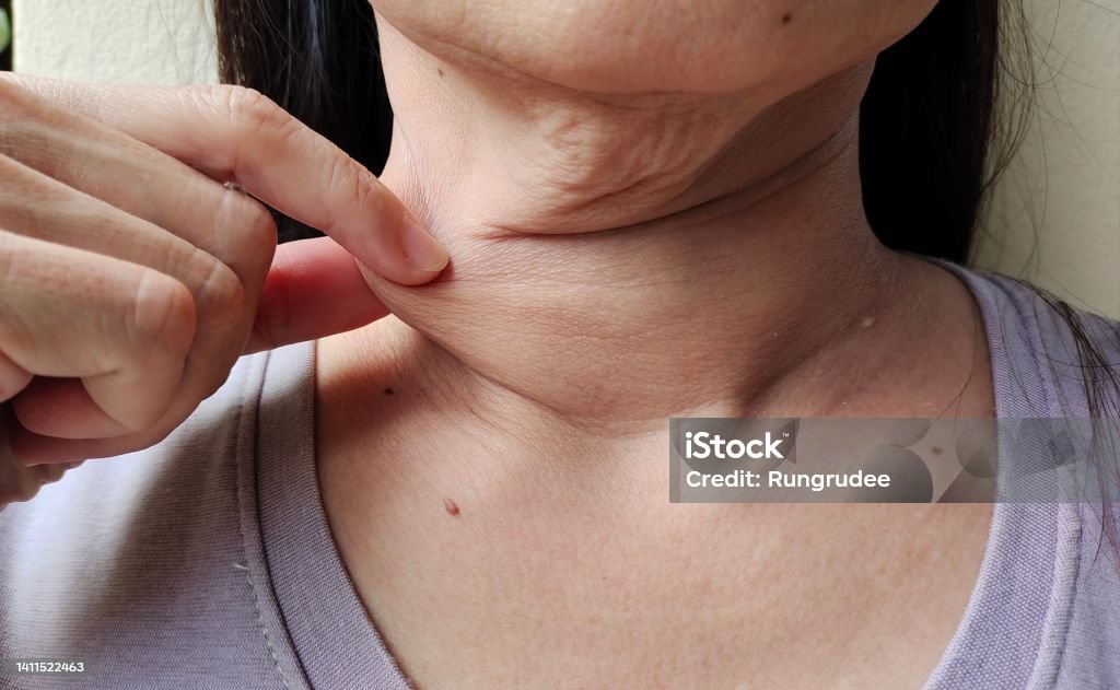 Flacidez facial y corporal