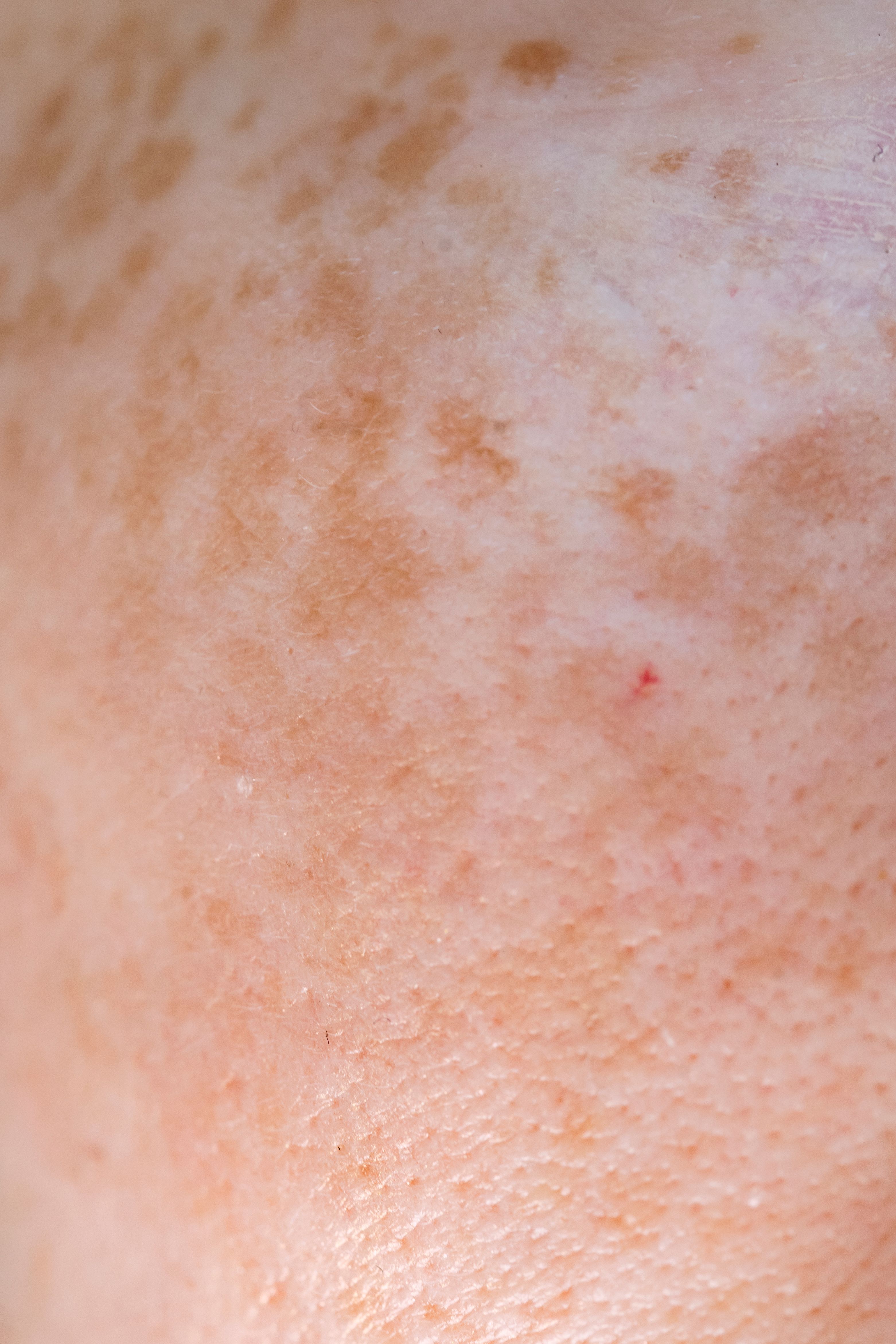 Manchas y melasma
